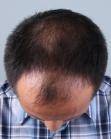 Before Hair Transplant&nbsp;Front